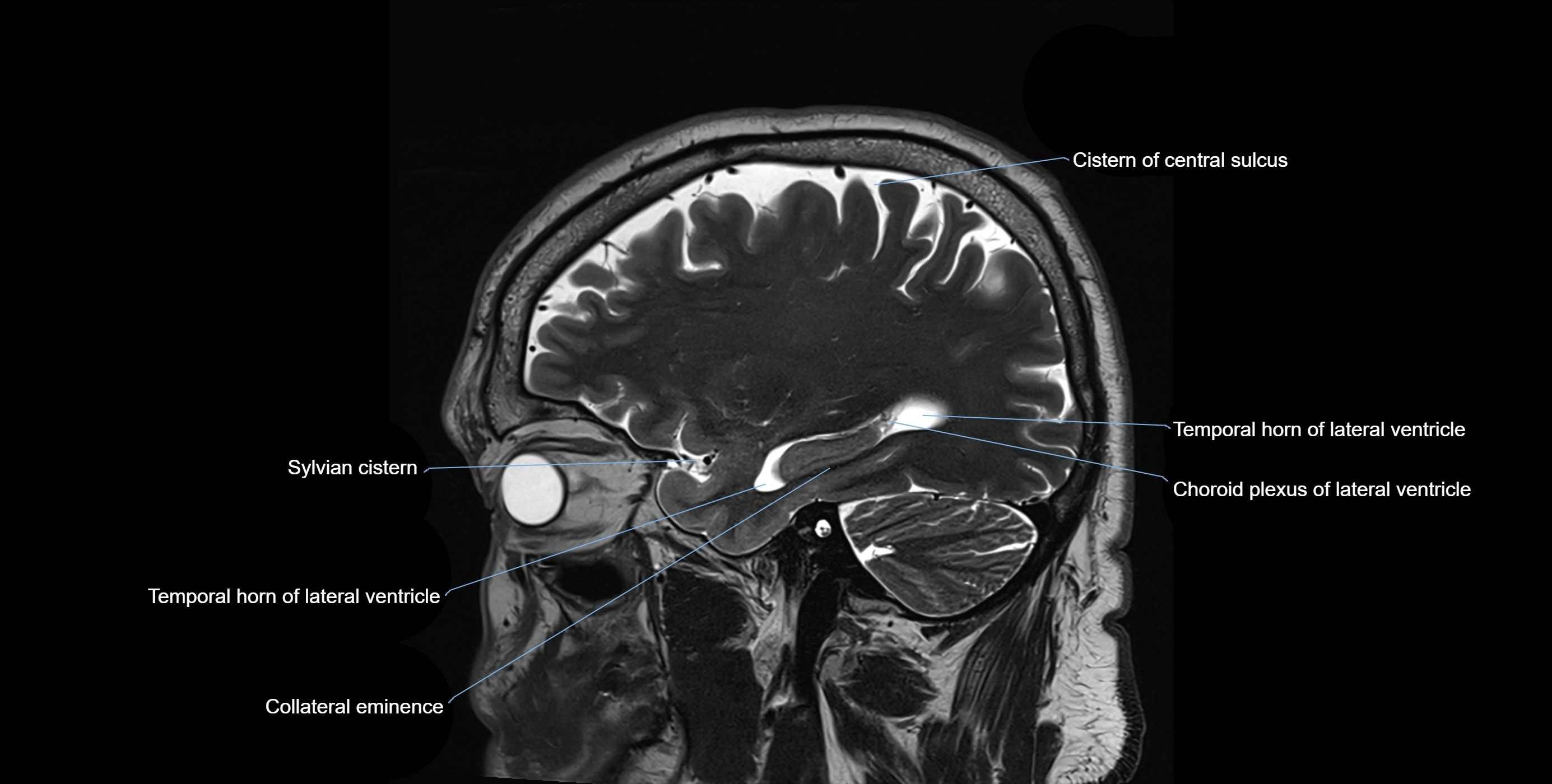 Brain cisterns  and ventricles sagittal anatomy 3T MRI image-img-00001-00015.webp